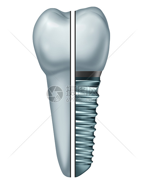 ‘~牙科种植牙骨内牙假体与正畸冠切除金属螺钉白色背景上分离的牙齿骨内牙假体的比较,正畸牙科手术象的三维插图  ~’ 的图片