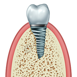 牙种植体牙齿假体的,颌骨牙龈内,用正畸冠切除金属螺钉白色背景上分离,正畸牙科手术的象,三维插图图片