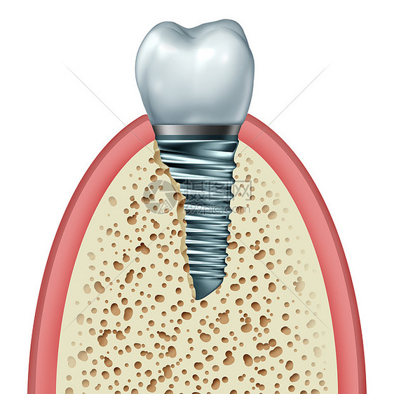 牙种植体牙齿假体的,颌骨牙龈内,用正畸冠切除金属螺钉白色背景上分离,正畸牙科手术的象,三维插图图片