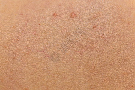 皮肤上皮肤病的人护肤问题的扩张的毛细血管,蜘蛛静脉,红色凸滑雪与扩张的毛细血管红色斑点图片