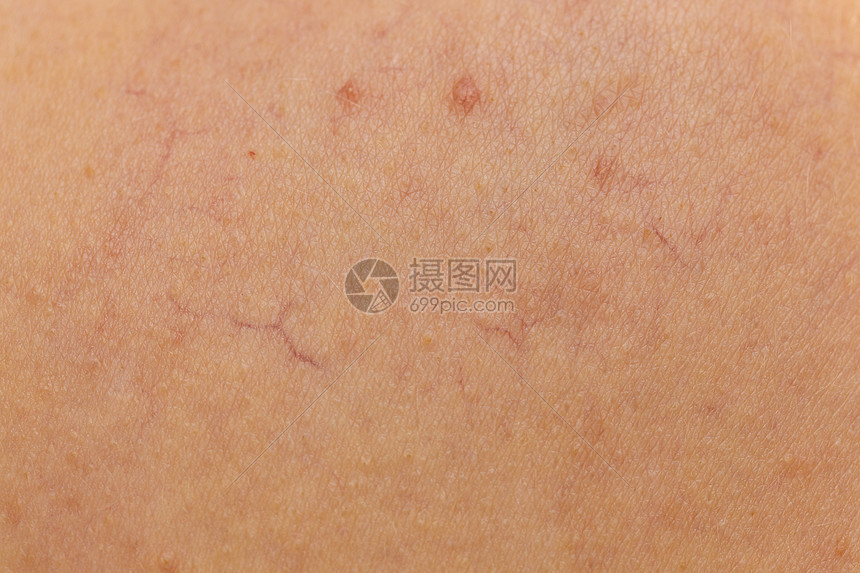 皮肤上皮肤病的人护肤问题的扩张的毛细血管蜘蛛静脉红色凸滑雪与扩张