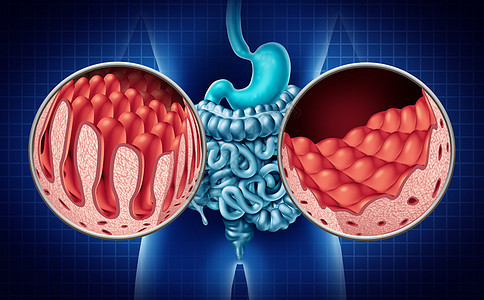 腹腔腹腔,疾病的肠道解剖医学与正常绒毛受损的小肠衬里自身免疫疾病的消化系统,结肠胃三维图示图片