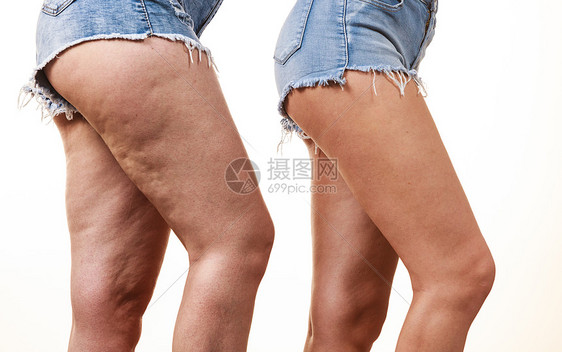 女腿部大腿与非纤维素的比较皮肤问题,身体护理,超重节食的腿与含纤维素的比较图片