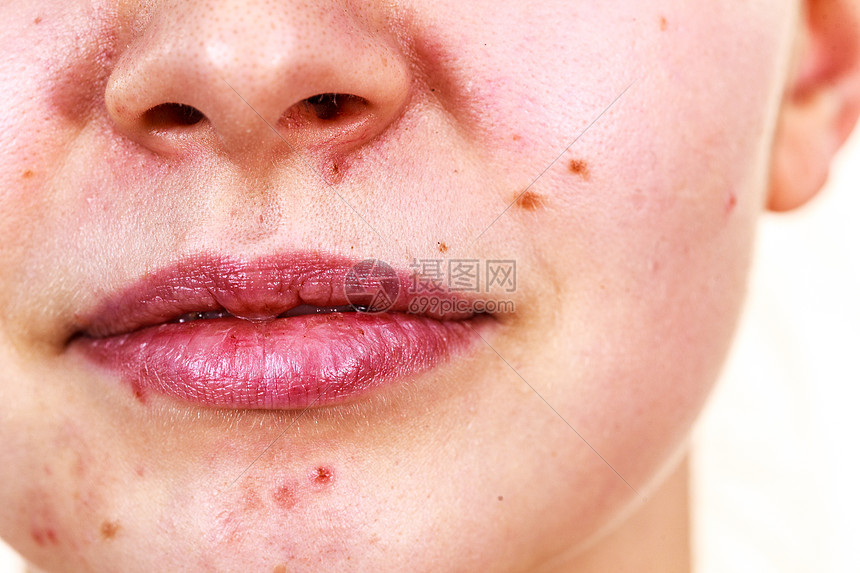 干燥的嘴唇女孩下巴痤疮青春痘图片