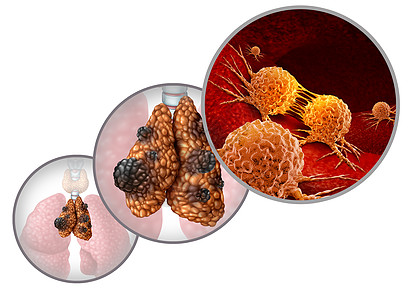 胸腺癌疾病胸腺瘤胸腺癌疾病种腺体解剖疾病,生长恶变异细胞生长,个图标,白色背景上分离出三维插图元素图片