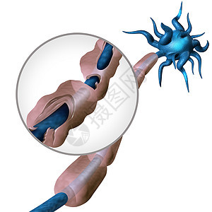 多发硬化图MS自身免疫疾病解剖与健康神经受损髓鞘暴露纤维与疤痕雪旺细胞鞘丢失三维图图片