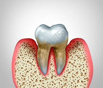 牙周炎牙龈疾病口腔卫生良的健康问题细菌感染图的,以炎症为三维图图片