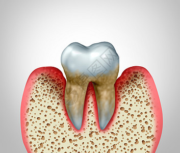 牙周炎牙龈疾病口腔卫生良的健康问题细菌感染图的,以炎症为三维图图片
