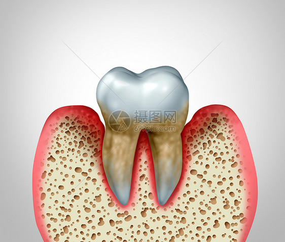 牙周炎牙龈疾病口腔卫生良的健康问题细菌感染图的,以炎症为三维图图片