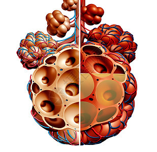 肺炎肺泡与液体图肺泡炎症解剖图健康健康的肺解剖呼吸医学的医学,白色上分离的三维图图片