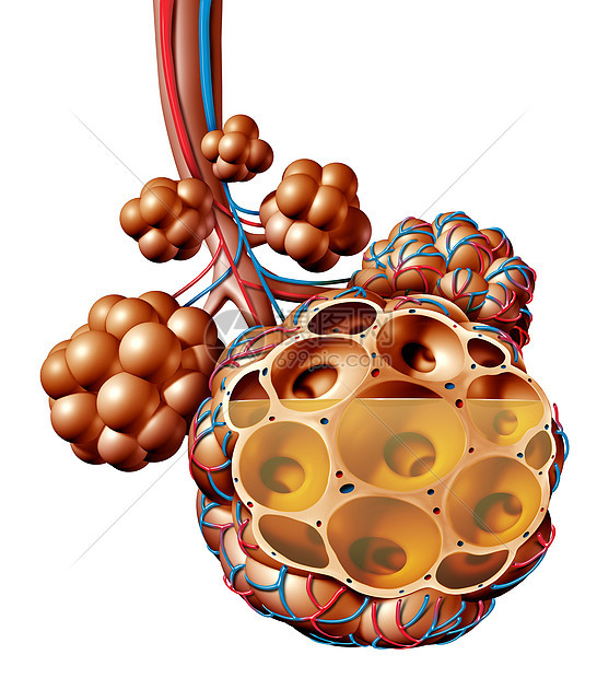 肺炎肺泡与液体肺泡炎症解剖图个医学的肺解剖呼吸医学个三维插图隔离白色背景图片