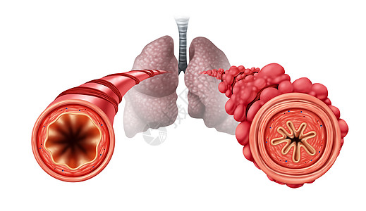 爆米花肺状况闭塞细支气管炎疾病阻塞支气管收缩所致的呼吸肌收紧肿胀与三维插图元素图片