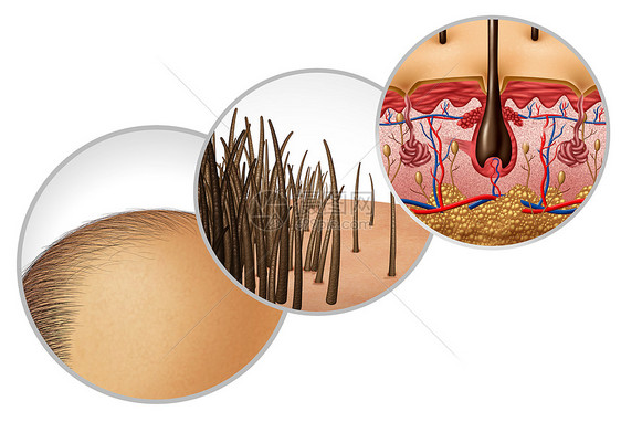 脱发图秃头秃头脱发种后退的发际线化妆品毛囊变薄脱发皮肤解剖与三维插图元素的特写图片