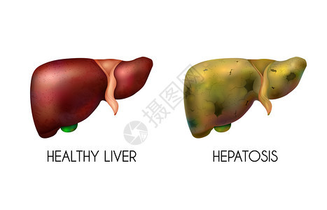 现实的人体内脏,肝脏,健康的,正常的,健康的脂肪成分,两种同的颜色,当疾病矢量插图背景图片