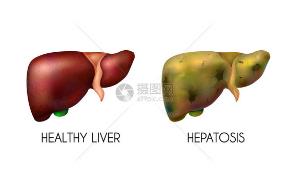 现实的人体内脏,肝脏,健康的,正常的,健康的脂肪成分,两种同的颜色,当疾病矢量插图图片