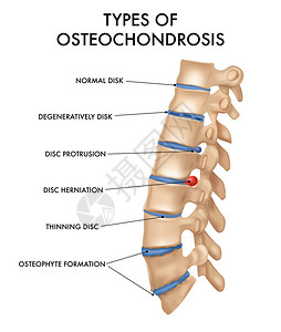 脊柱节段脊柱椎间疝骨软骨病理学图现实医学教育解剖教科书海报矢量插图背景图片