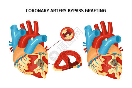 冠状动脉旁路移植术平矢量图示心脏解剖背景图片