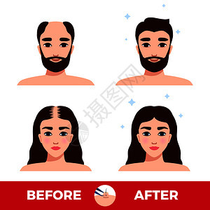 男女头发移植前后的白色背景平矢量插图背景图片