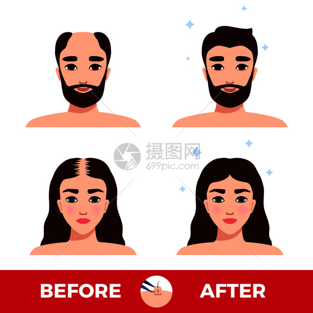 男女头发移植前后的白色背景平矢量插图图片