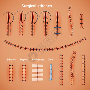 手术缝合缝合线真实的缝合方法形状与订书机胶水文本标题矢量插图背景图片