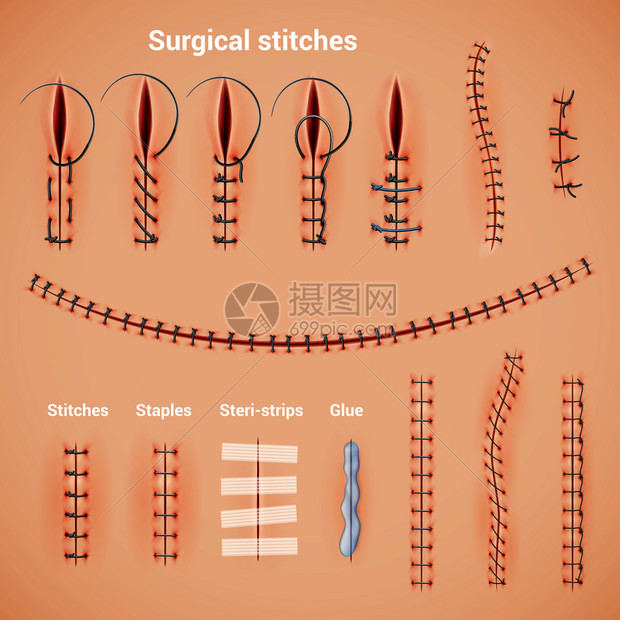 手术缝合缝合线真实的缝合方法形状与订书机胶水文本标题矢量插图插画图片下载 正版图片 摄图网