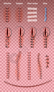 手术缝合缝合线透明背景上的真实图像集与同形状的医疗缝合矢量插图图片