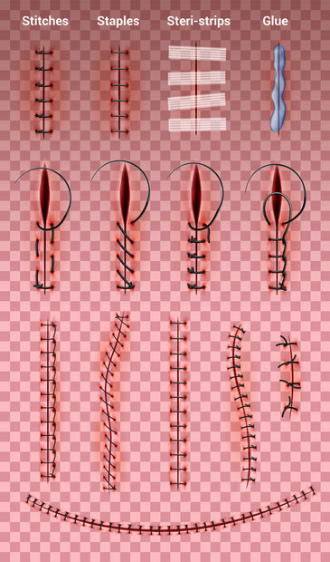 手术缝合缝合线透明背景上的真实图像集与同形状的医疗缝合矢量插图图片