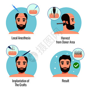 与胡须男子头发移植过程的阶段分离矢量插图图片