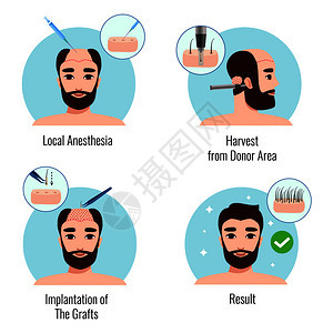 与胡须男子头发移植过程的阶段分离矢量插图背景图片