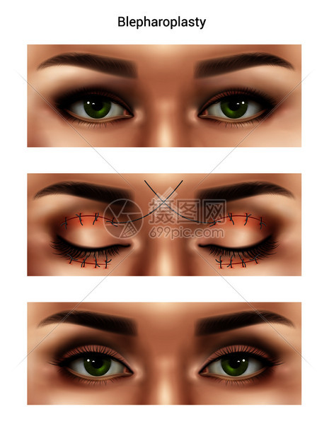 手术缝合缝合线的真实成与女眼睛的图像同阶段的眼睑成形术程序矢量插图图片
