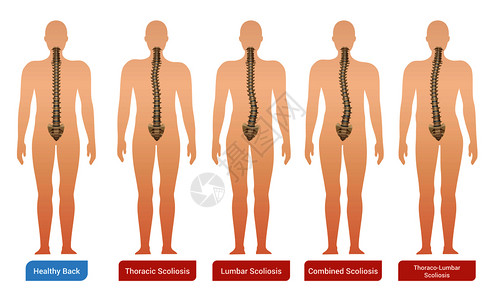 脊柱弯曲脊柱侧凸医学信息图像与人体轮廓脊柱文本矢量插图背景图片
