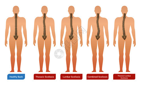 脊柱弯曲脊柱侧凸医学信息图像与人体轮廓脊柱文本矢量插图图片