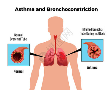 哮喘发作医学教育图表海报与描绘正常发炎的支气管平向量插图图片