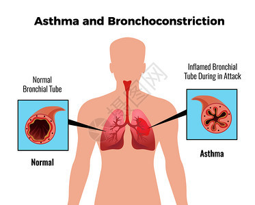 哮喘发作医学教育图表海报与描绘正常发炎的支气管平向量插图图片