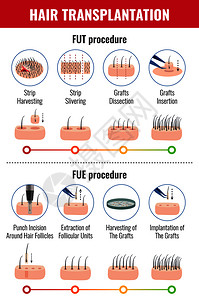 头发移植的方法与程序信息的阶段白色背景矢量插图背景图片