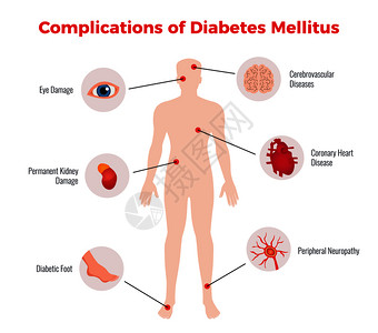 糖尿病并发症医学教育图表海报与受影响的人体器官损害描述描述平矢量插图图片