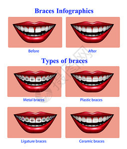张开的嘴与红色光泽的嘴唇金属塑料陶瓷牙套类型真实的信息矢量插图图片