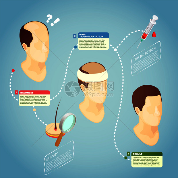 头发移植等距矢量插图与描述手术程序恢复头发秃头毛发移植载体插图图片