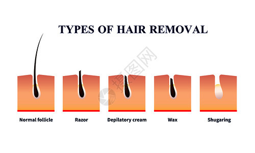 正常卵泡类型的脱毛帮助剃须刀,脱毛膏,蜡,含糖矢量插图脱毛插图的类型背景图片