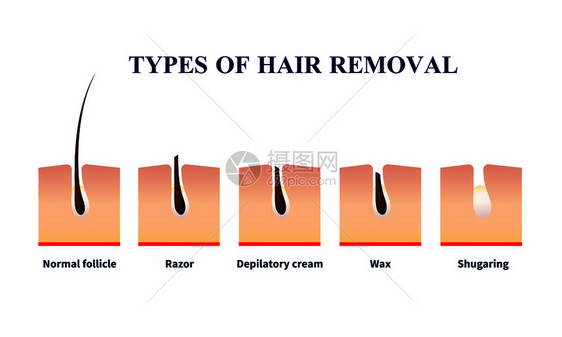 正常卵泡类型的脱毛帮助剃须刀,脱毛膏,蜡,含糖矢量插图脱毛插图的类型图片