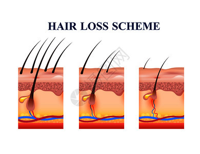 人皮肤脱发阶段,解剖结构方案,包括卵泡静脉神经矢量图脱发计划背景图片