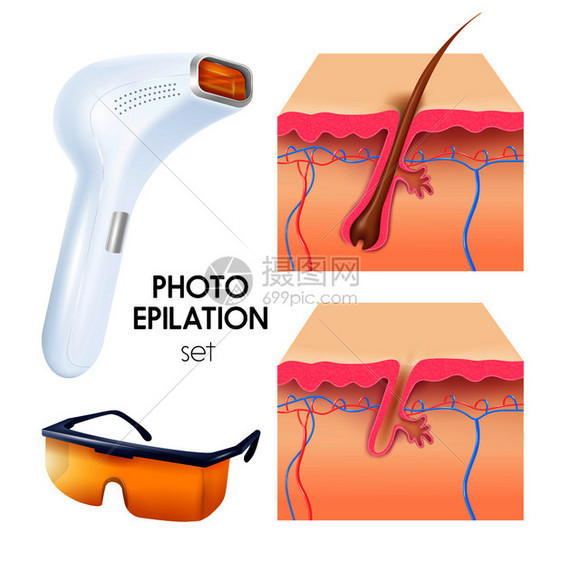 照片脱毛逼真与脱毛保护护目镜横截的皮肤层方案矢量插图照片脱毛写实套装图片