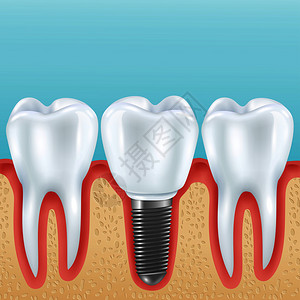 牙科假肢现实向量插图与健康牙齿义齿冠植入种植体种植牙的现实插图插画