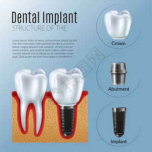 健康牙冠基牙种植体附近义齿修复信息海报的结构,真实的图标矢量插图真实的牙科种植信息图图片