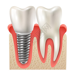 牙种植体牙套闭合模型牙种植体牙套模型特写侧视真实图像矢量图图片