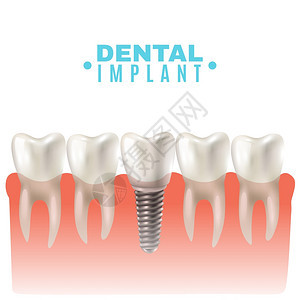 牙科种植模型侧视海报牙科种植模型特写剪侧视图教育医学海报矢量插图图片
