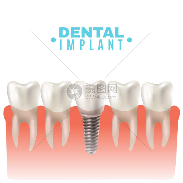 牙科种植模型侧视海报牙科种植模型特写剪侧视图教育医学海报矢量插图图片