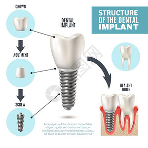牙科种植结构医学信息海报牙种植体结构医学图示教育信息海报与磨牙替代健康工具模型矢量插图图片