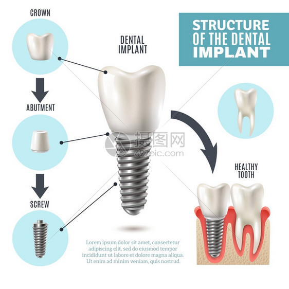 牙科种植结构医学信息海报牙种植体结构医学图示教育信息海报与磨牙替代健康工具模型矢量插图图片