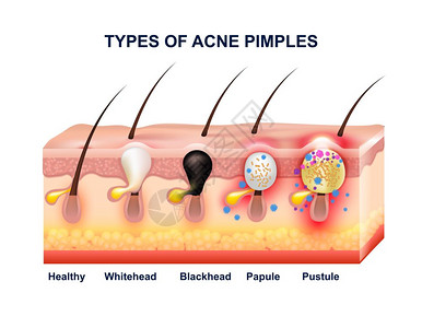 皮肤痤疮解剖成彩色皮肤痤疮解剖成与类型的痤疮粉刺前后矢量插图图片